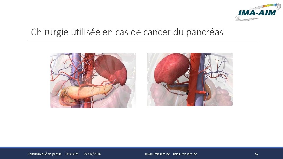 Chirurgie utilisée en cas de cancer du pancréas Communiqué de presse IMA-AIM 24/04/2016 www.