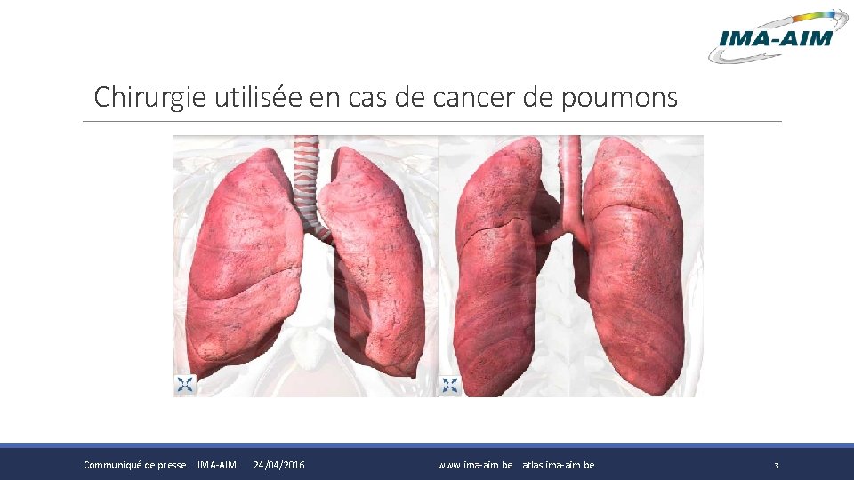 Chirurgie utilisée en cas de cancer de poumons Communiqué de presse IMA-AIM 24/04/2016 www.