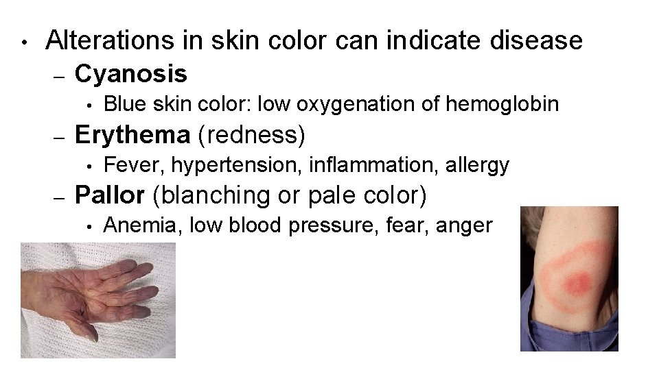  • Alterations in skin color can indicate disease – Cyanosis • – Erythema