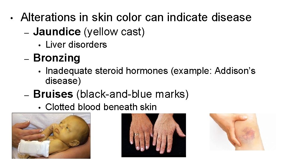  • Alterations in skin color can indicate disease – Jaundice (yellow cast) •