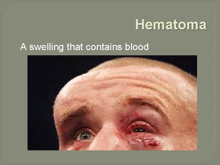 Hematoma �A swelling that contains blood 