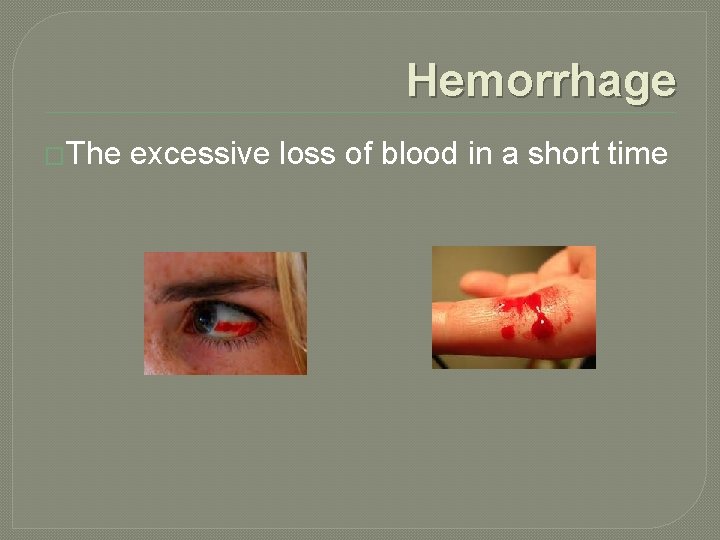 Hemorrhage �The excessive loss of blood in a short time 