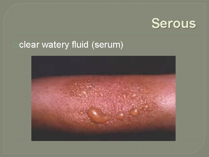 Serous �clear watery fluid (serum) 
