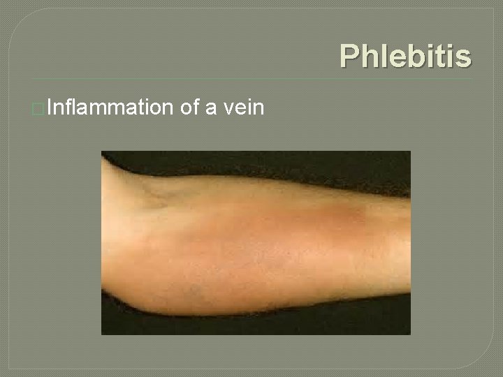 Phlebitis �Inflammation of a vein 