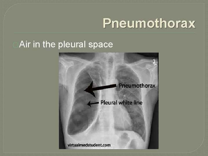 Pneumothorax �Air in the pleural space 