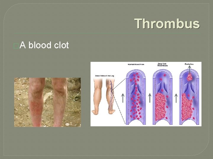 Thrombus �A blood clot 