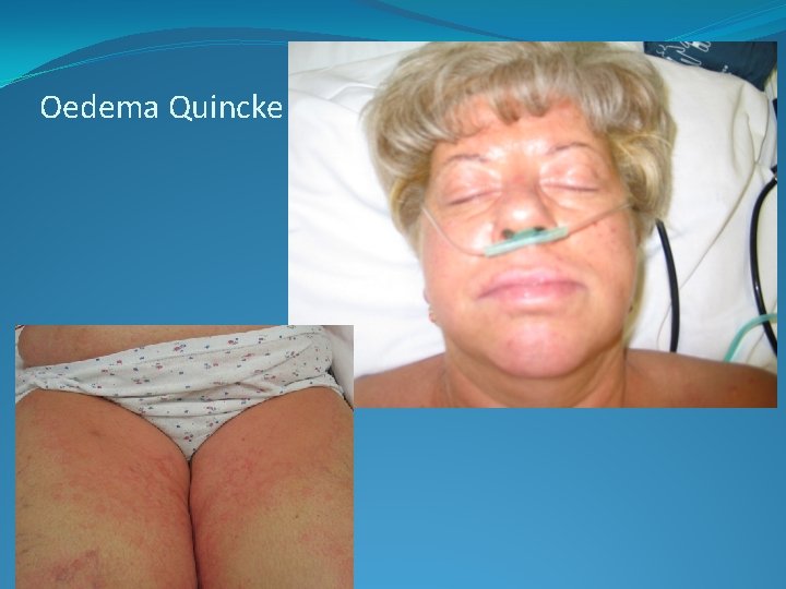 Oedema Quincke 