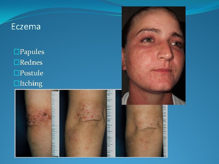 Eczema �Papules �Rednes �Pustule �Itching 