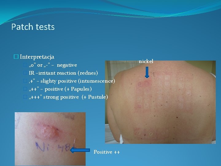 Patch tests � Interpretacja nickel � „ 0” or „-” – negative � IR