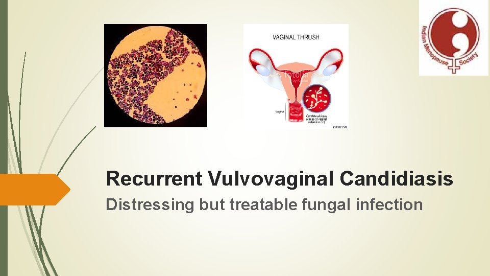 Recurrent Vulvovaginal Candidiasis Distressing but treatable fungal infection 