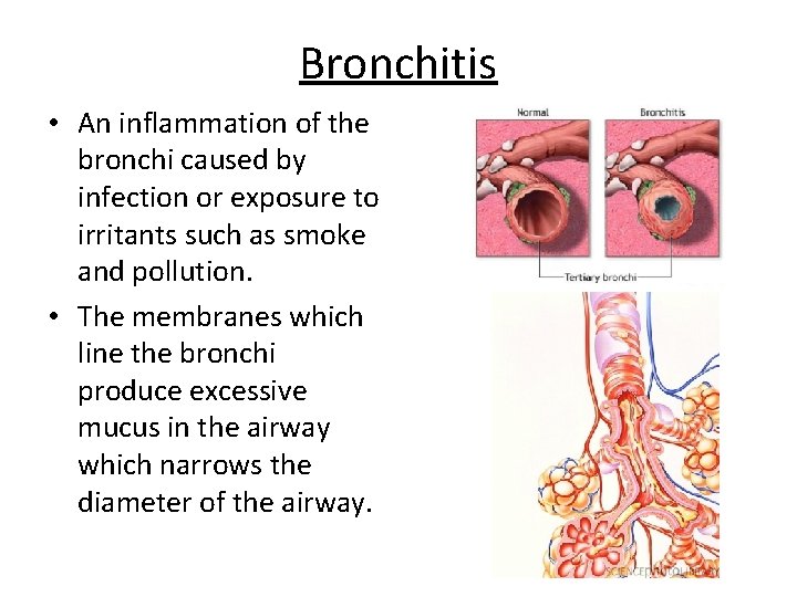 Bronchitis • An inflammation of the bronchi caused by infection or exposure to irritants