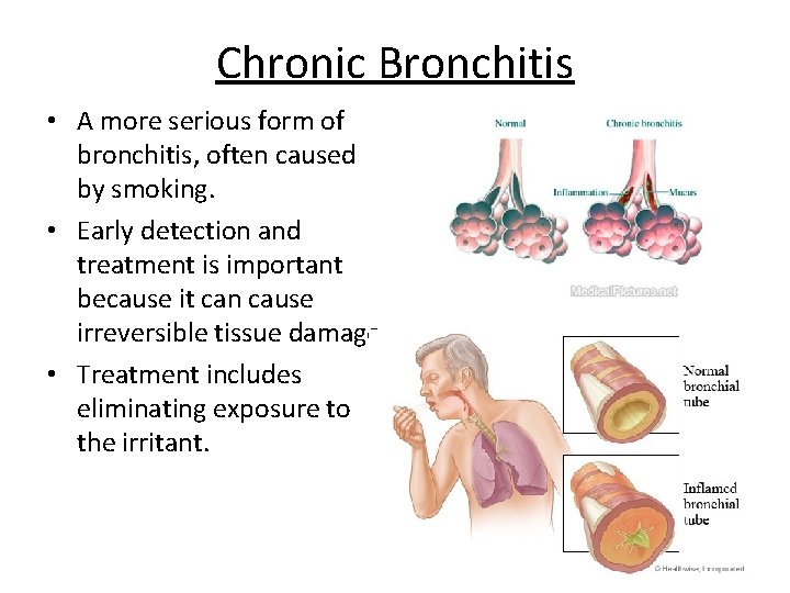 Chronic Bronchitis • A more serious form of bronchitis, often caused by smoking. •