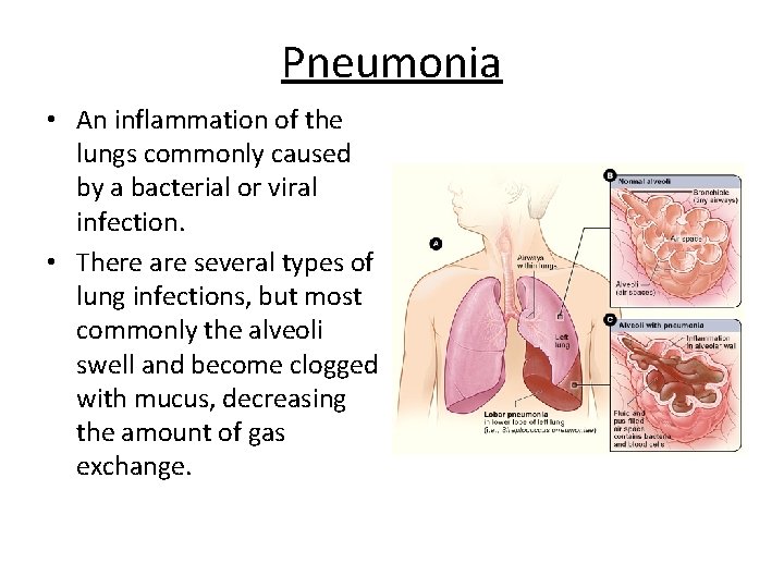 Pneumonia • An inflammation of the lungs commonly caused by a bacterial or viral