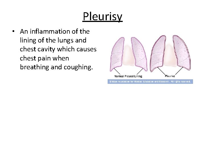 Pleurisy • An inflammation of the lining of the lungs and chest cavity which