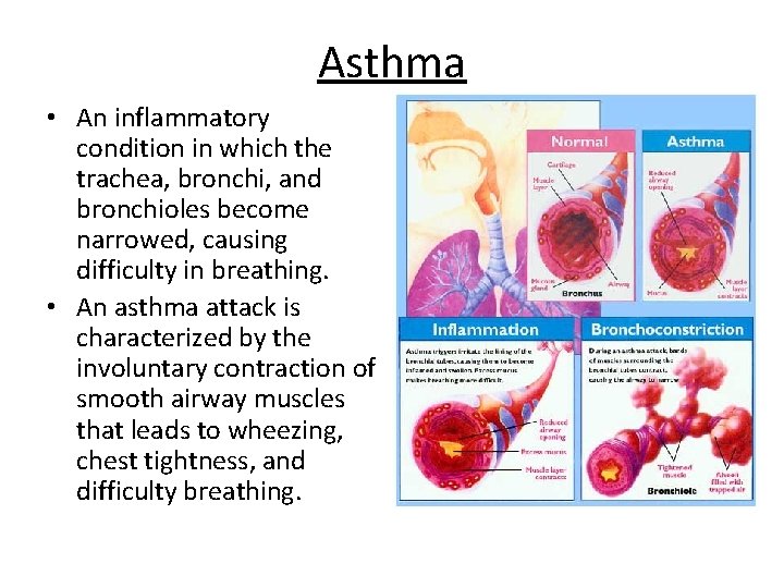 Asthma • An inflammatory condition in which the trachea, bronchi, and bronchioles become narrowed,