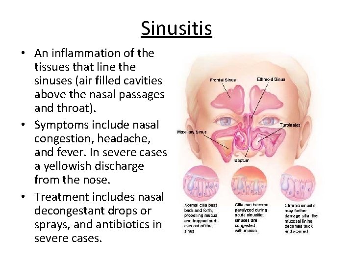Sinusitis • An inflammation of the tissues that line the sinuses (air filled cavities