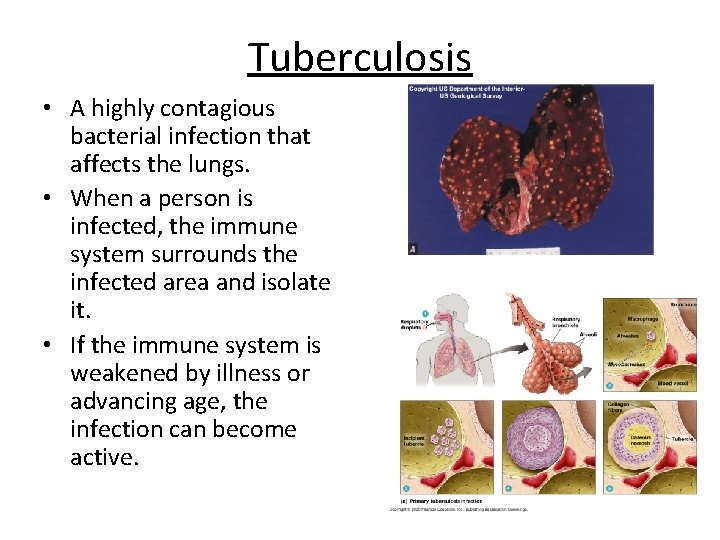 Tuberculosis • A highly contagious bacterial infection that affects the lungs. • When a