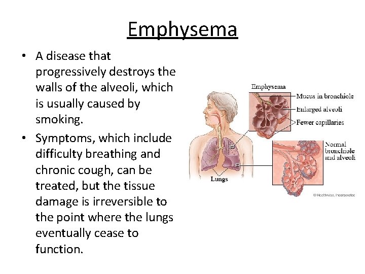 Emphysema • A disease that progressively destroys the walls of the alveoli, which is