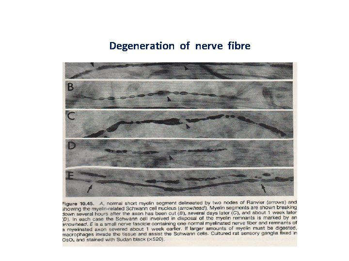 Degeneration of nerve fibre 