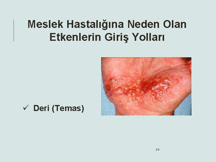 Meslek Hastalığına Neden Olan Etkenlerin Giriş Yolları ü Deri (Temas) 24 