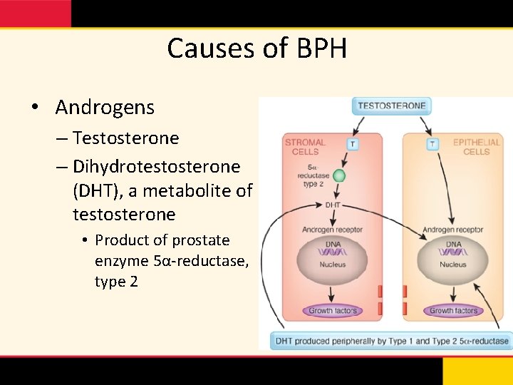 Prostate Embolization New Treatment Option for BPH Howard
