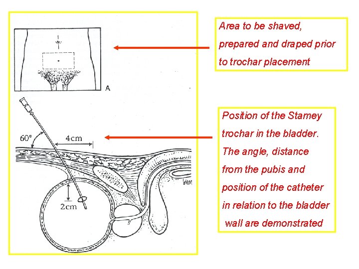 Area to be shaved, prepared and draped prior to trochar placement Position of the Area to be shaved, prepared and draped prior to trochar placement Position of the