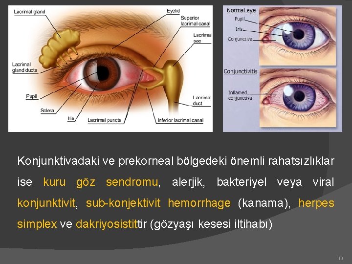 Konjunktivadaki ve prekorneal bölgedeki önemli rahatsızlıklar ise kuru göz sendromu, alerjik, bakteriyel veya viral