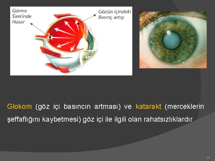 Glokom (göz içi basıncın artması) ve katarakt (merceklerin şeffaflığını kaybetmesi) göz içi ile ilgili