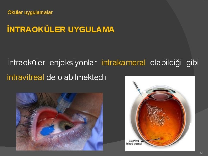 Oküler uygulamalar İNTRAOKÜLER UYGULAMA İntraoküler enjeksiyonlar intrakameral olabildiği gibi intravitreal de olabilmektedir 45 