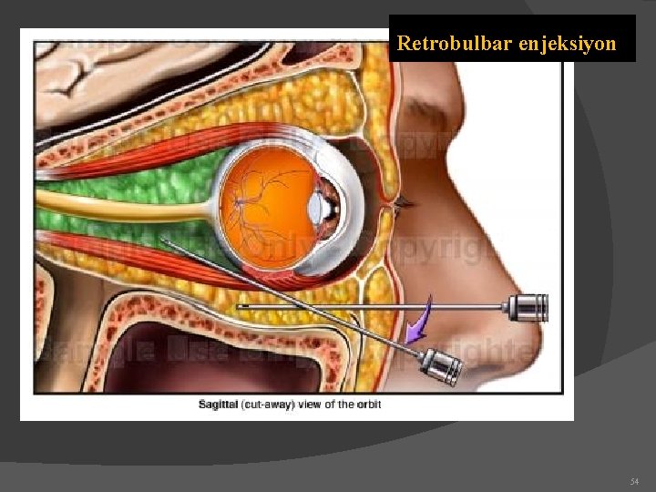 Retrobulbar enjeksiyon 54 