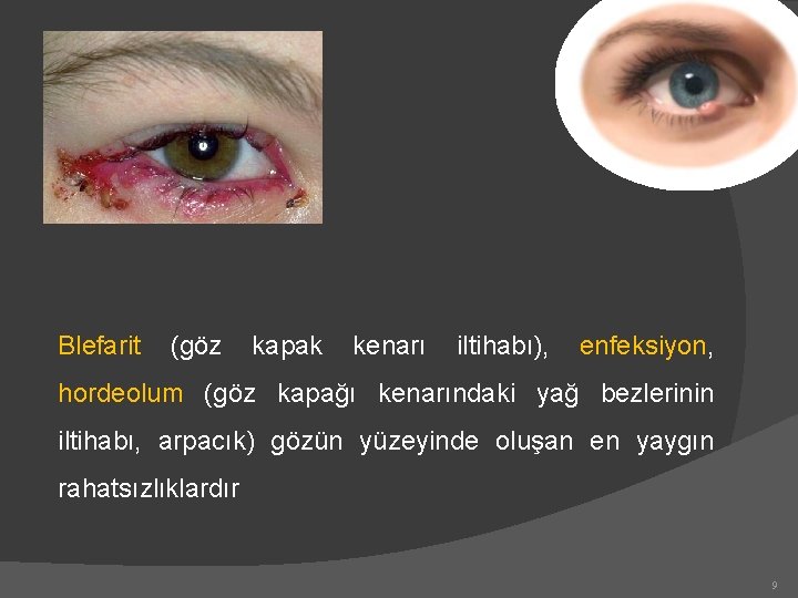 Blefarit (göz kapak kenarı iltihabı), enfeksiyon, hordeolum (göz kapağı kenarındaki yağ bezlerinin iltihabı, arpacık)