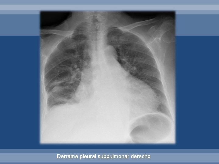 Derrame pleural subpulmonar derecho 