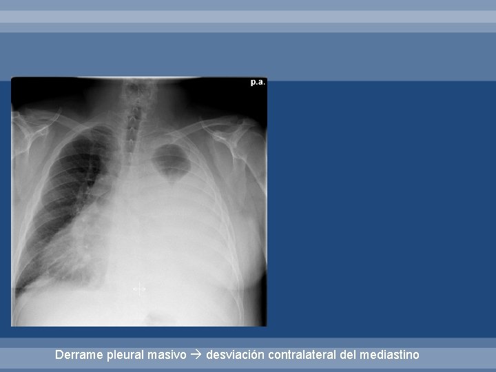 Derrame pleural masivo desviación contralateral del mediastino 