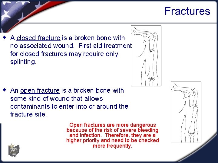 Fractures w A closed fracture is a broken bone with no associated wound. First