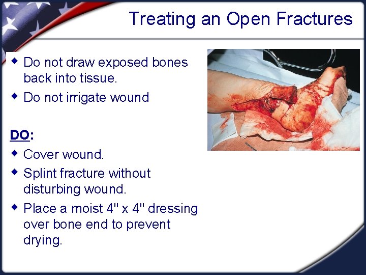 Treating an Open Fractures w Do not draw exposed bones w back into tissue.