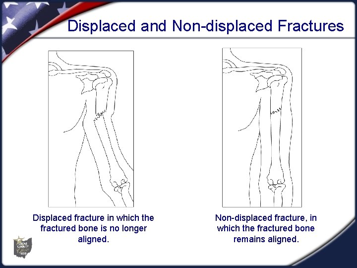 Displaced and Non-displaced Fractures Displaced fracture in which the fractured bone is no longer