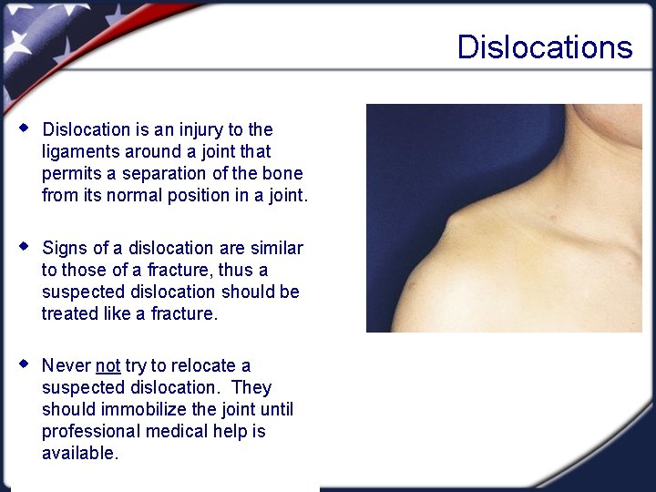 Dislocations w Dislocation is an injury to the ligaments around a joint that permits