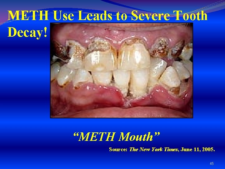 METH Use Leads to Severe Tooth Decay! “METH Mouth” Source: The New York Times,