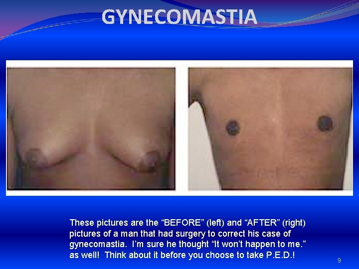 GYNECOMASTIA These pictures are the “BEFORE” (left) and “AFTER” (right) pictures of a man