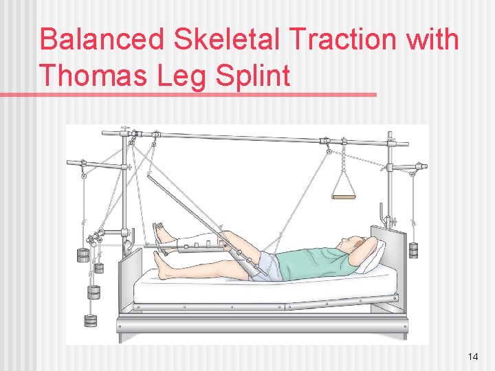 Balanced Skeletal Traction with Thomas Leg Splint 14 