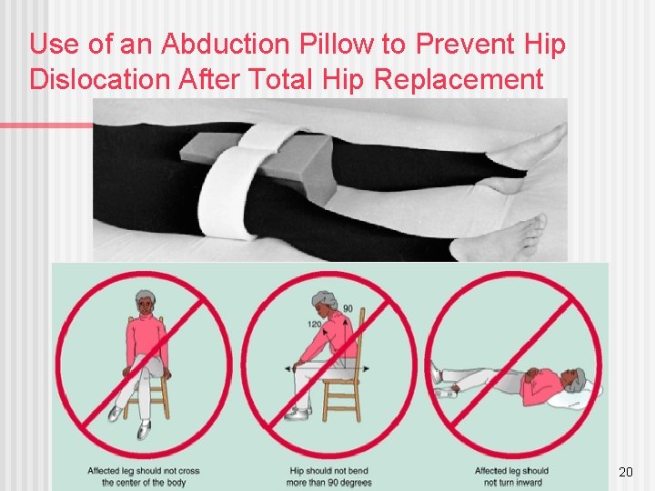 Use of an Abduction Pillow to Prevent Hip Dislocation After Total Hip Replacement 20
