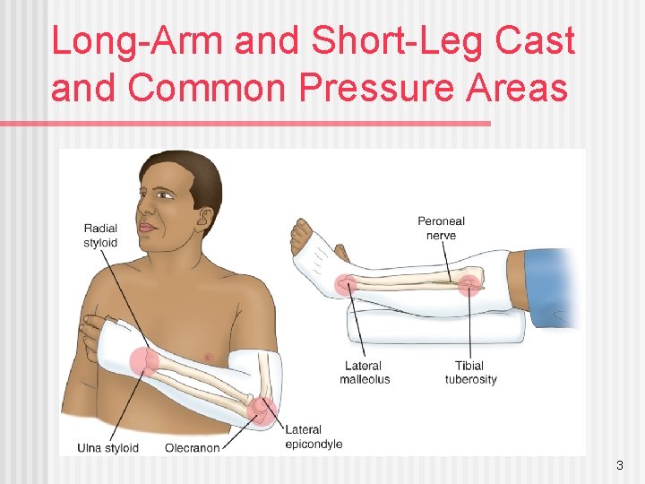 Long-Arm and Short-Leg Cast and Common Pressure Areas 3 