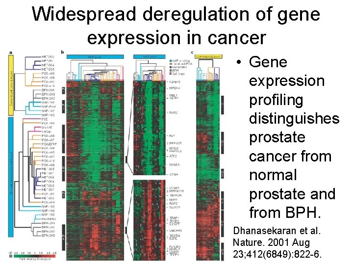 Widespread deregulation of gene expression in cancer • Gene expression profiling distinguishes prostate cancer