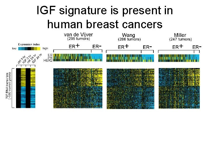IGF signature is present in human breast cancers 