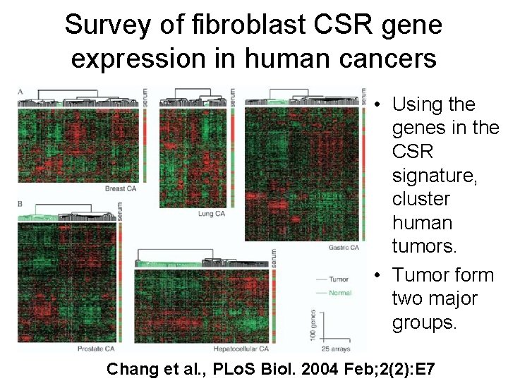 Survey of fibroblast CSR gene expression in human cancers • Using the genes in