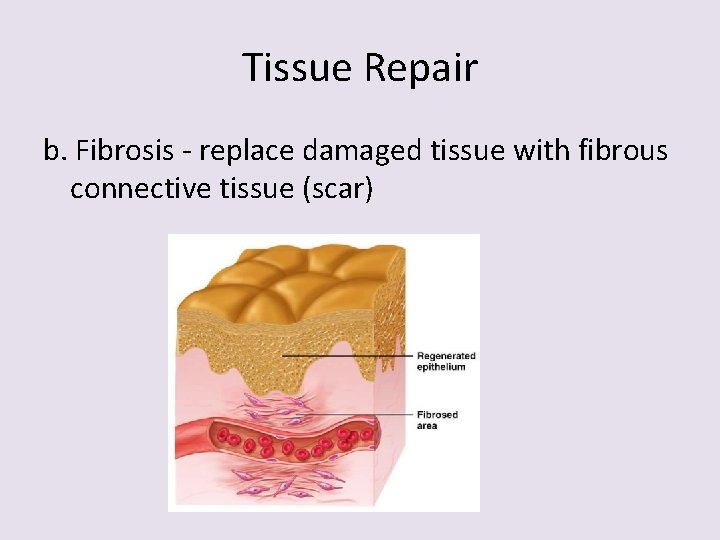 Tissue Repair b. Fibrosis - replace damaged tissue with fibrous connective tissue (scar) 