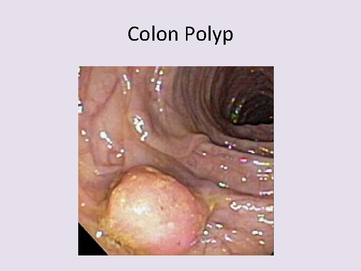 Colon Polyp 