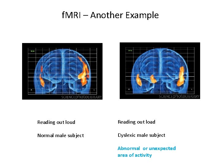 f. MRI – Another Example Reading out loud Reading out load Normal male subject