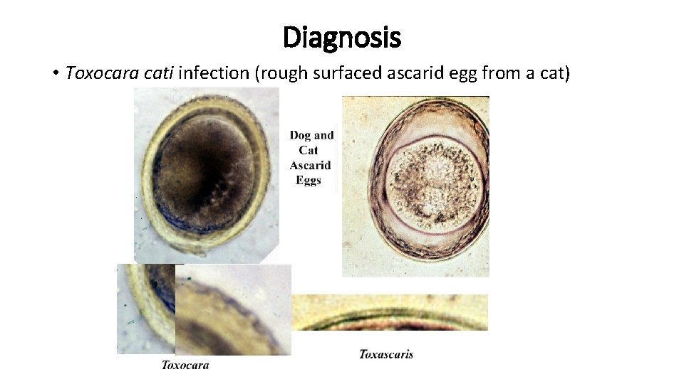 Diagnosis • Toxocara cati infection (rough surfaced ascarid egg from a cat) 