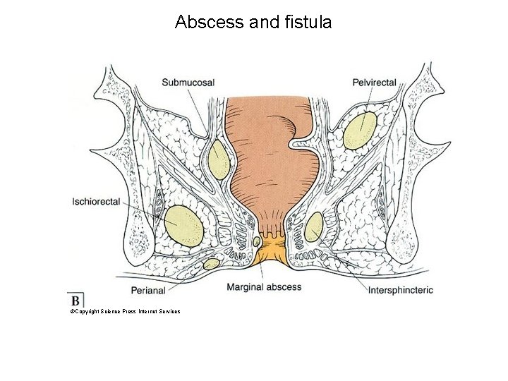 Abscess and fistula ©Copyright Science Press Internet Services 